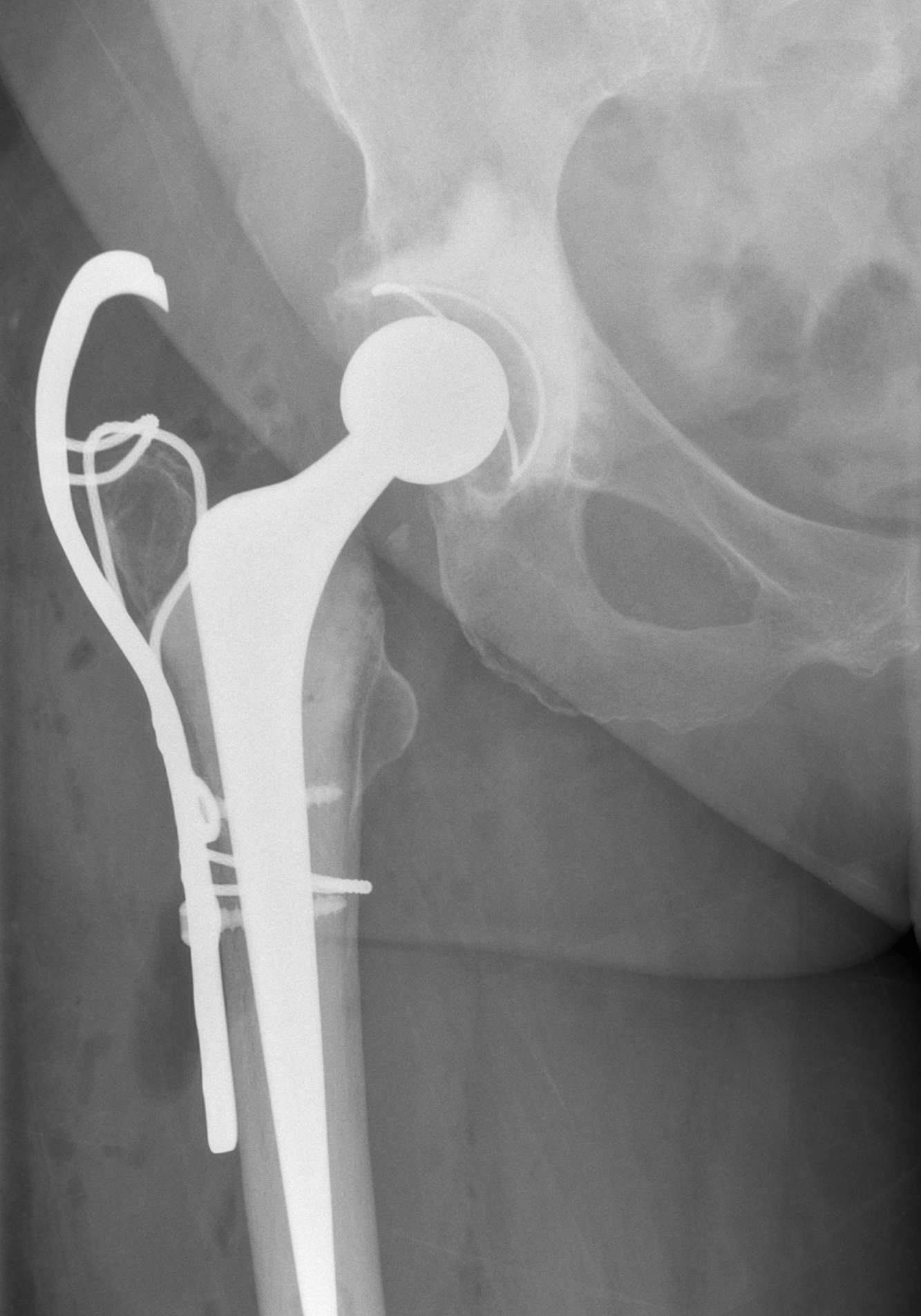 GT Osteotomy Plate Fixation